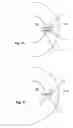 Fig. 11 - Glaucoma drainage device with pump