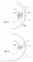 Fig. 11 - Power saving glaucoma drainage device