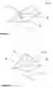 Fig. 05 - Spinal cannula having liquor detection