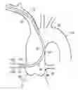 Fig. 01 - Catheter for coronary artery and engaging method therefor