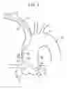 Fig. 07 - Catheter for coronary artery and engaging method therefor