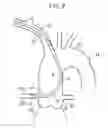 Fig. 08 - Catheter for coronary artery and engaging method therefor