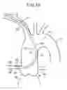 Fig. 11 - Catheter for coronary artery and engaging method therefor