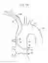 Fig. 15 - Catheter for coronary artery and engaging method therefor
