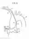 Fig. 16 - Catheter for coronary artery and engaging method therefor