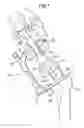 Fig. 02 - METHOD OF APPLYING A FEMORAL HEAD RESURFACING PROSTHESIS