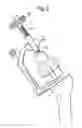 Fig. 04 - METHOD OF APPLYING A FEMORAL HEAD RESURFACING PROSTHESIS