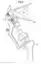 Fig. 06 - METHOD OF APPLYING A FEMORAL HEAD RESURFACING PROSTHESIS