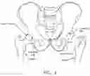Fig. 03 - Method and apparatus for re-attaching the labrum to the acetabulum, including the provision and use of a novel suture anchor system