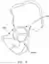 Fig. 06 - Method and apparatus for re-attaching the labrum to the acetabulum, including the provision and use of a novel suture anchor system