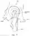 Fig. 08 - Method and apparatus for re-attaching the labrum to the acetabulum, including the provision and use of a novel suture anchor system
