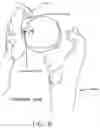 Fig. 09 - Method and apparatus for re-attaching the labrum to the acetabulum, including the provision and use of a novel suture anchor system