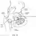 Fig. 10 - Method and apparatus for re-attaching the labrum to the acetabulum, including the provision and use of a novel suture anchor system