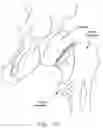 Fig. 11 - Method and apparatus for re-attaching the labrum to the acetabulum, including the provision and use of a novel suture anchor system