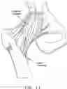 Fig. 12 - Method and apparatus for re-attaching the labrum to the acetabulum, including the provision and use of a novel suture anchor system