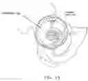Fig. 16 - Method and apparatus for re-attaching the labrum to the acetabulum, including the provision and use of a novel suture anchor system