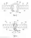 Fig. 03 - Tissue repair system