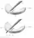 Fig. 14 - Method and apparatus for meniscal repair