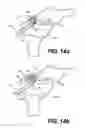 Fig. 15 - Suture passing devices and methods