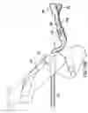Fig. 32 - Articulating suturing device and method