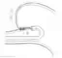 Fig. 13 - Method for Applying Surgical Clips Particularly Useful in the Endoluminal Treatment of Gastroesophageal Reflux Disease (GERD)