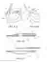 Fig. 34 - Symmetrical drive system for an implantable restriction device