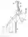 Fig. 34 - ARTICULATING SUTURING AND DEVICE AND METHOD