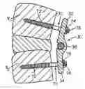 Fig. 01 - Composite vertebral rod system and methods of use