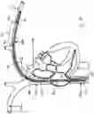 Fig. 14 - INTRAVASCULAR IMPLANTABLE DEVICE HAVING SUPERIOR ANCHORING ARRANGEMENT