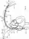 Fig. 15 - INTRAVASCULAR IMPLANTABLE DEVICE HAVING SUPERIOR ANCHORING ARRANGEMENT