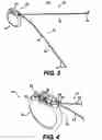 Fig. 04 - Obstructive Sleep Apnea Treatment Devices, Systems and Methods
