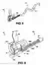 Fig. 05 - Obstructive Sleep Apnea Treatment Devices, Systems and Methods