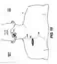 Fig. 08 - Obstructive Sleep Apnea Treatment Devices, Systems and Methods