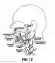 Fig. 10 - Obstructive Sleep Apnea Treatment Devices, Systems and Methods