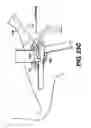 Fig. 16 - Obstructive Sleep Apnea Treatment Devices, Systems and Methods