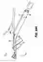 Fig. 17 - Obstructive Sleep Apnea Treatment Devices, Systems and Methods