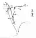 Fig. 19 - Obstructive Sleep Apnea Treatment Devices, Systems and Methods