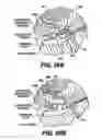 Fig. 20 - Obstructive Sleep Apnea Treatment Devices, Systems and Methods