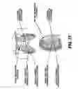 Fig. 33 - Obstructive Sleep Apnea Treatment Devices, Systems and Methods