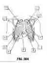 Fig. 34 - Obstructive Sleep Apnea Treatment Devices, Systems and Methods