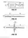 Fig. 38 - Obstructive Sleep Apnea Treatment Devices, Systems and Methods