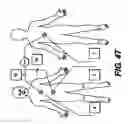 Fig. 40 - Obstructive Sleep Apnea Treatment Devices, Systems and Methods