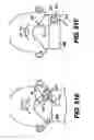 Fig. 45 - Obstructive Sleep Apnea Treatment Devices, Systems and Methods