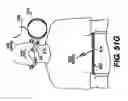Fig. 46 - Obstructive Sleep Apnea Treatment Devices, Systems and Methods