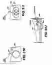 Fig. 47 - Obstructive Sleep Apnea Treatment Devices, Systems and Methods
