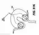Fig. 48 - Obstructive Sleep Apnea Treatment Devices, Systems and Methods