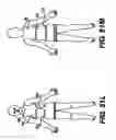 Fig. 49 - Obstructive Sleep Apnea Treatment Devices, Systems and Methods