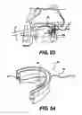 Fig. 57 - Obstructive Sleep Apnea Treatment Devices, Systems and Methods