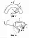 Fig. 58 - Obstructive Sleep Apnea Treatment Devices, Systems and Methods