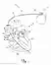 Fig. 02 - CARDIAC LEAD WELDING